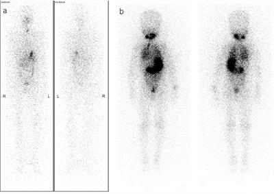 Radioiodine adjuvant therapy in differentiated thyroid cancer: An update and reconsideration